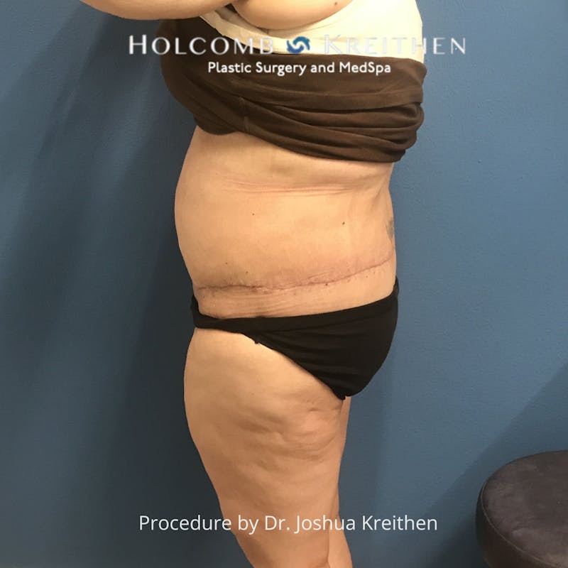 Lower Body Lift Before & After Gallery - Patient 189380 - Image 6