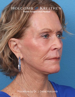 TRL Laser Skin Resurfacing Before & After Gallery - Patient 110641 - Image 8