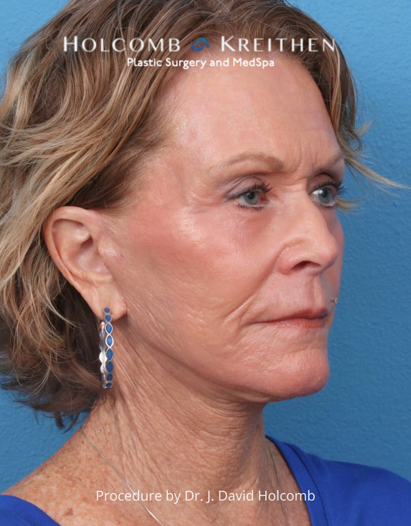 TRL Laser Skin Resurfacing Before & After Gallery - Patient 110641 - Image 8