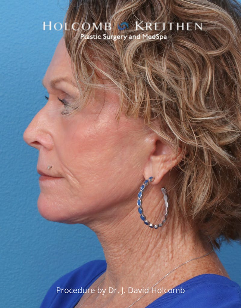 TRL Laser Skin Resurfacing Before & After Gallery - Patient 110641 - Image 6