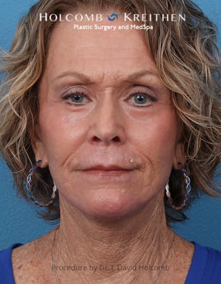 TRL Laser Skin Resurfacing Before & After Gallery - Patient 110641 - Image 2