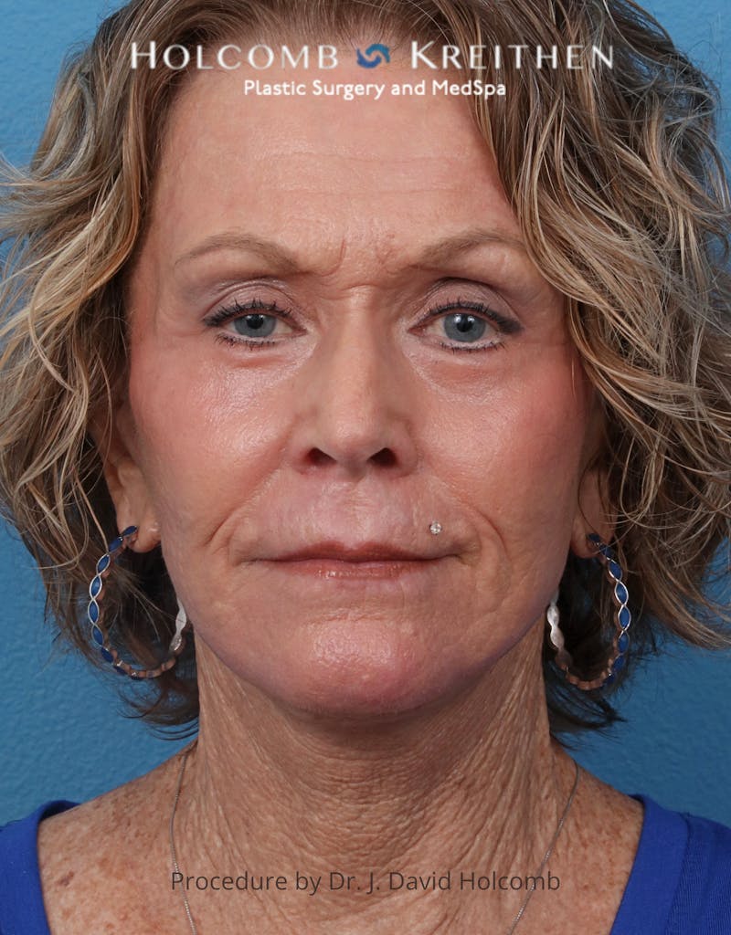TRL Laser Skin Resurfacing Before & After Gallery - Patient 110641 - Image 2