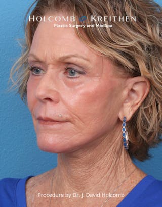 TRL Laser Skin Resurfacing Before & After Gallery - Patient 110641 - Image 4