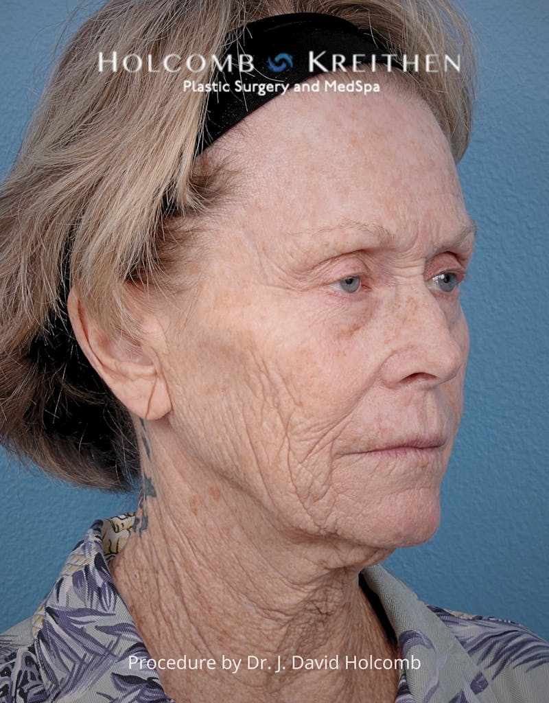 TRL Laser Skin Resurfacing Before & After Gallery - Patient 110641 - Image 7