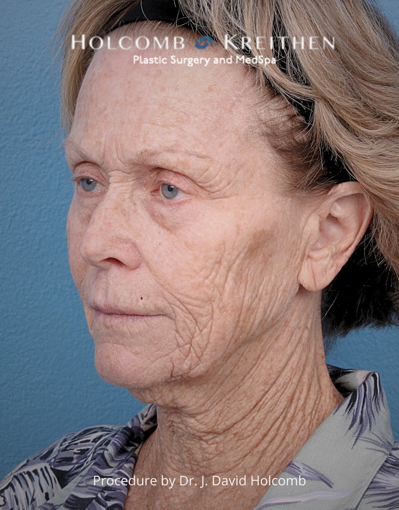 TRL Laser Skin Resurfacing Before & After Gallery - Patient 110641 - Image 3