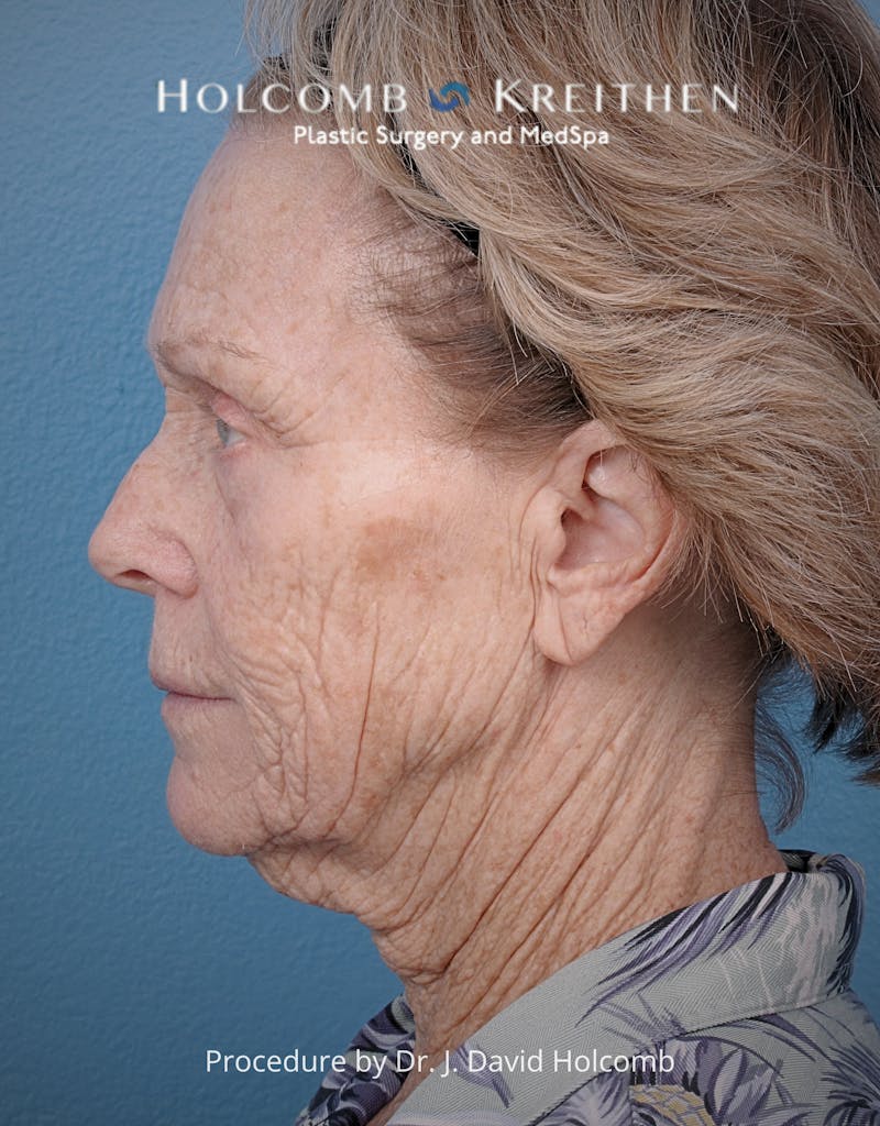 TRL Laser Skin Resurfacing Before & After Gallery - Patient 110641 - Image 5