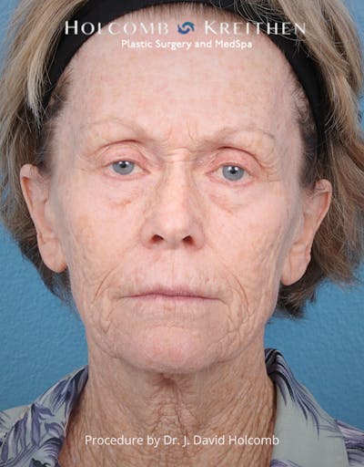 TRL Laser Skin Resurfacing Before & After Gallery - Patient 110641 - Image 1