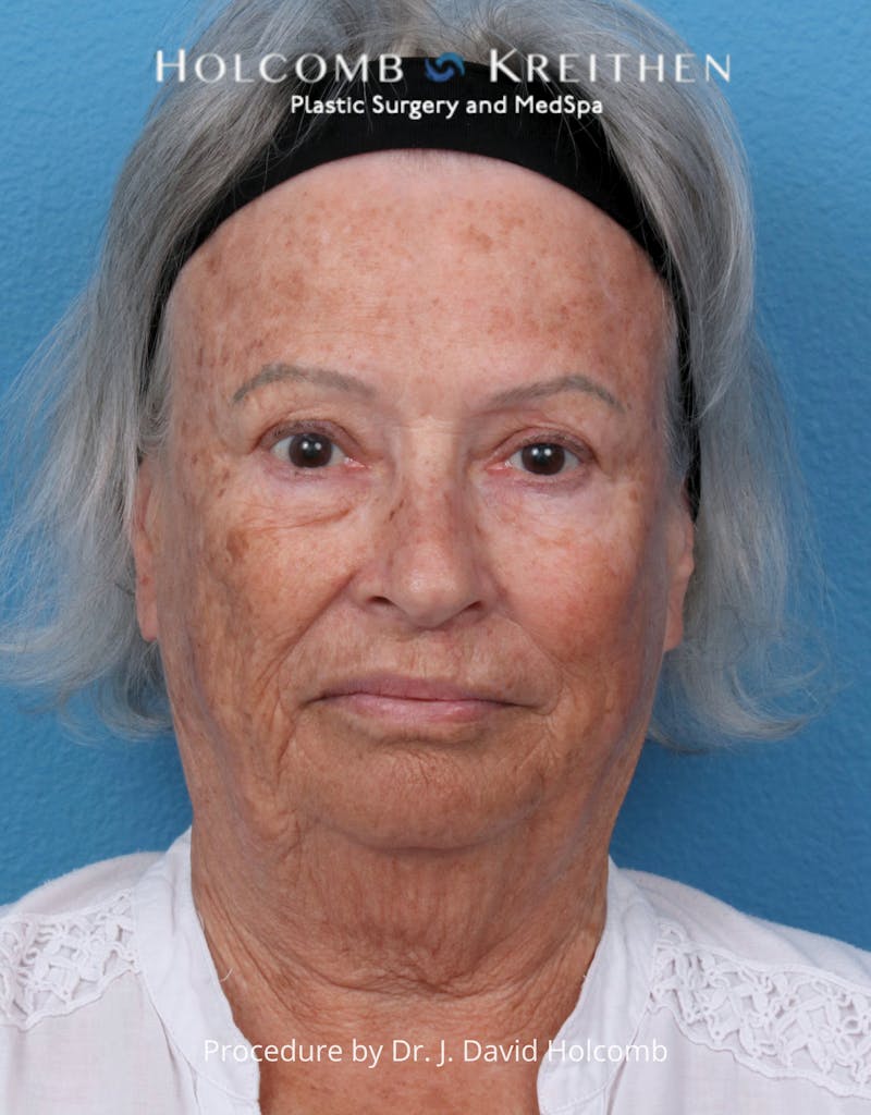 eCO2 Fractional Laser Before & After Gallery - Patient 126536 - Image 1