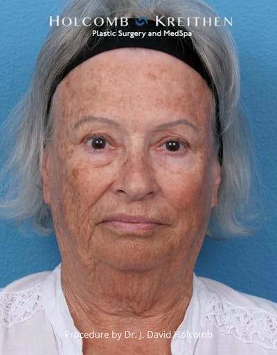 Facelift Before & After Gallery - Patient 238719 - Image 1