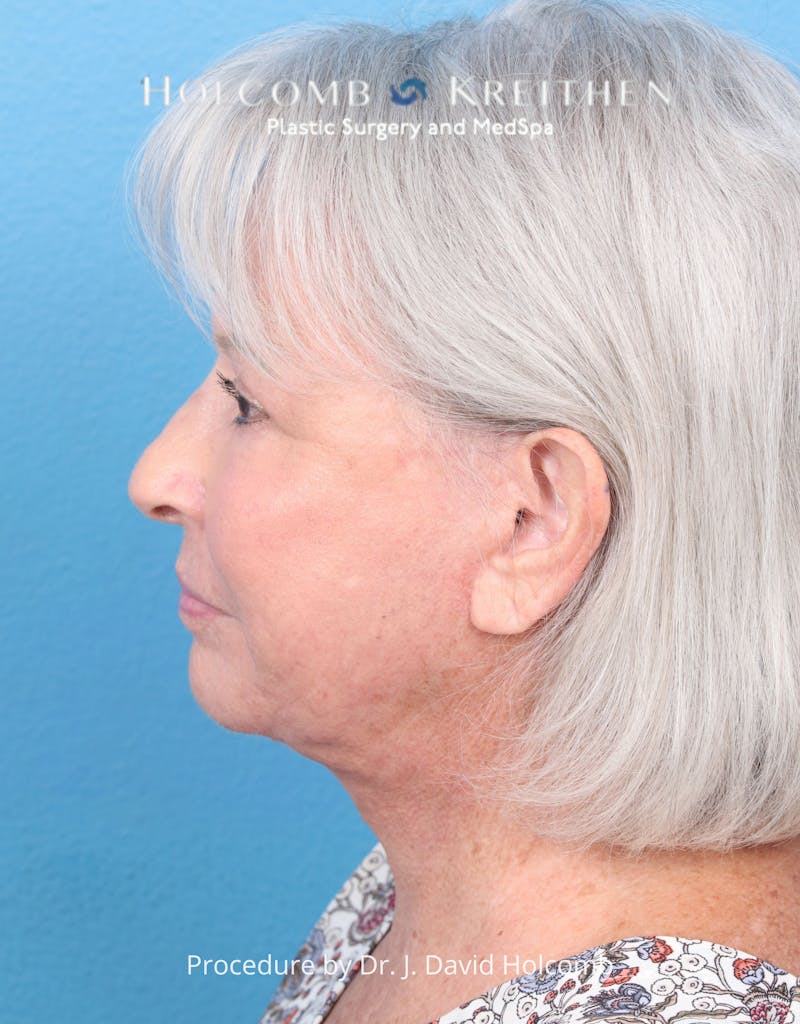 eCO2 Fractional Laser Before & After Gallery - Patient 126536 - Image 10