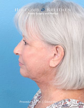 Facelift Before & After Gallery - Patient 238719 - Image 10