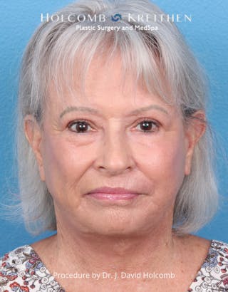 Facelift Before & After Gallery - Patient 238719 - Image 2