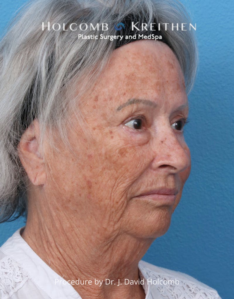 eCO2 Fractional Laser Before & After Gallery - Patient 126536 - Image 3