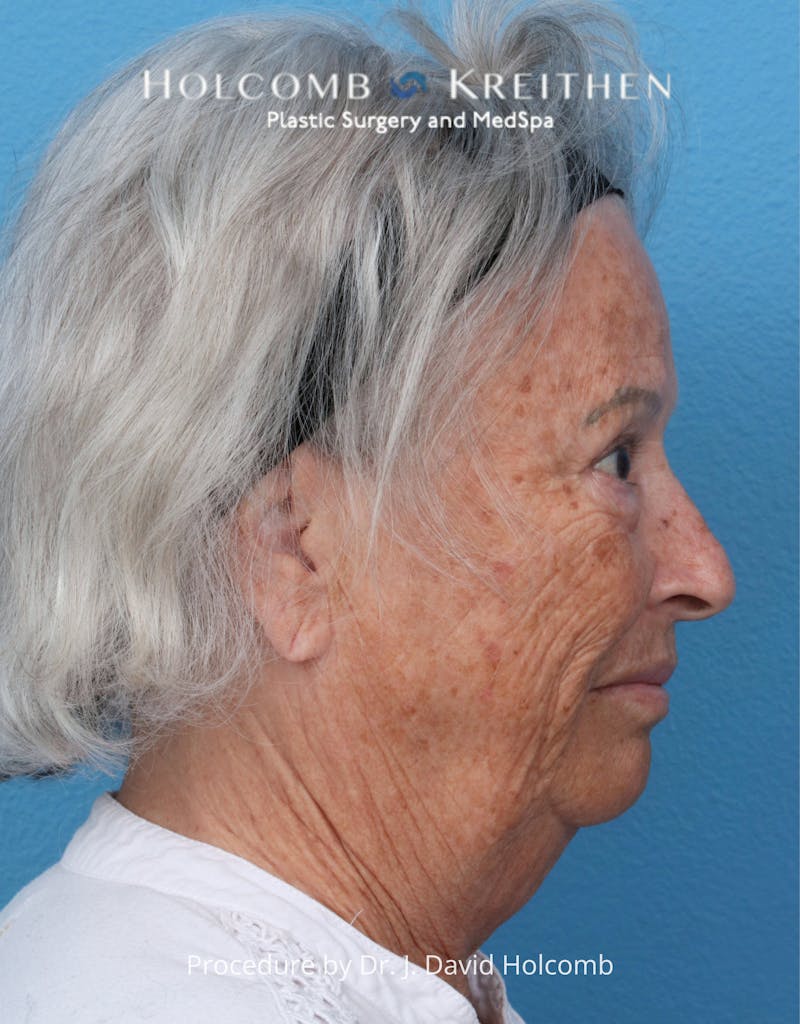 eCO2 Fractional Laser Before & After Gallery - Patient 126536 - Image 5