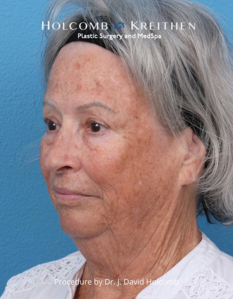 eCO2 Fractional Laser Before & After Gallery - Patient 126536 - Image 7