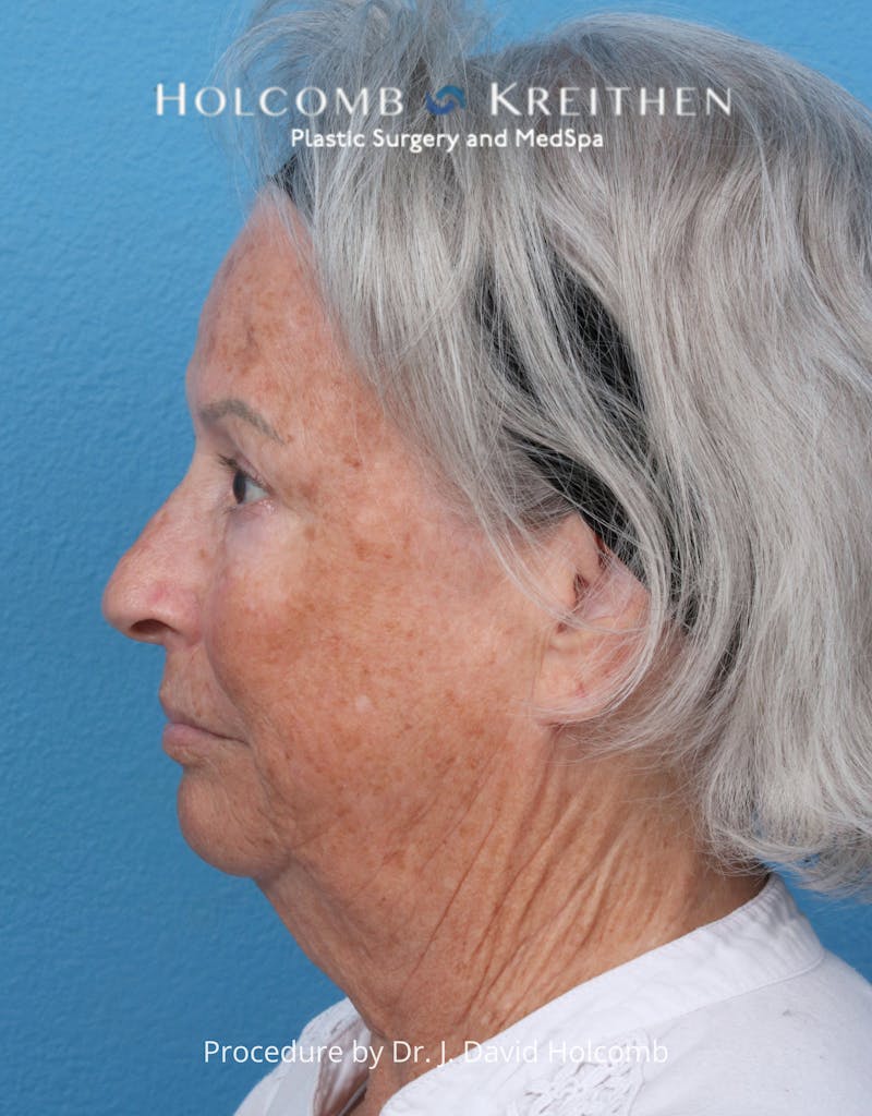 eCO2 Fractional Laser Before & After Gallery - Patient 126536 - Image 9
