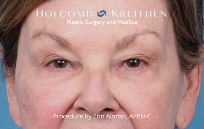 Ultraclear Before & After Gallery - Patient 318069 - Image 1