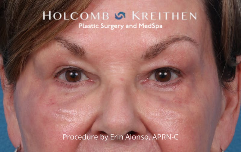 Ultraclear Before & After Gallery - Patient 318069 - Image 2