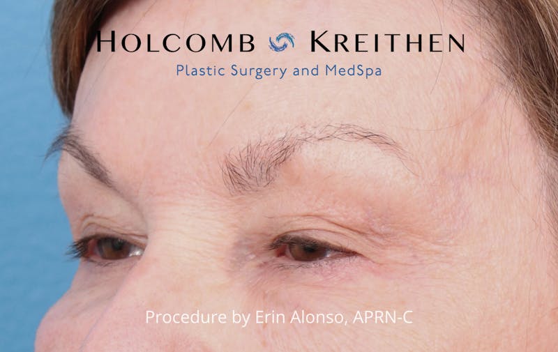 Ultraclear Before & After Gallery - Patient 318069 - Image 3