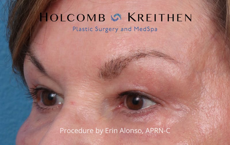 Ultraclear Before & After Gallery - Patient 318069 - Image 4