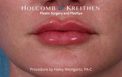 Filler Before & After Gallery - Patient 350055 - Image 2
