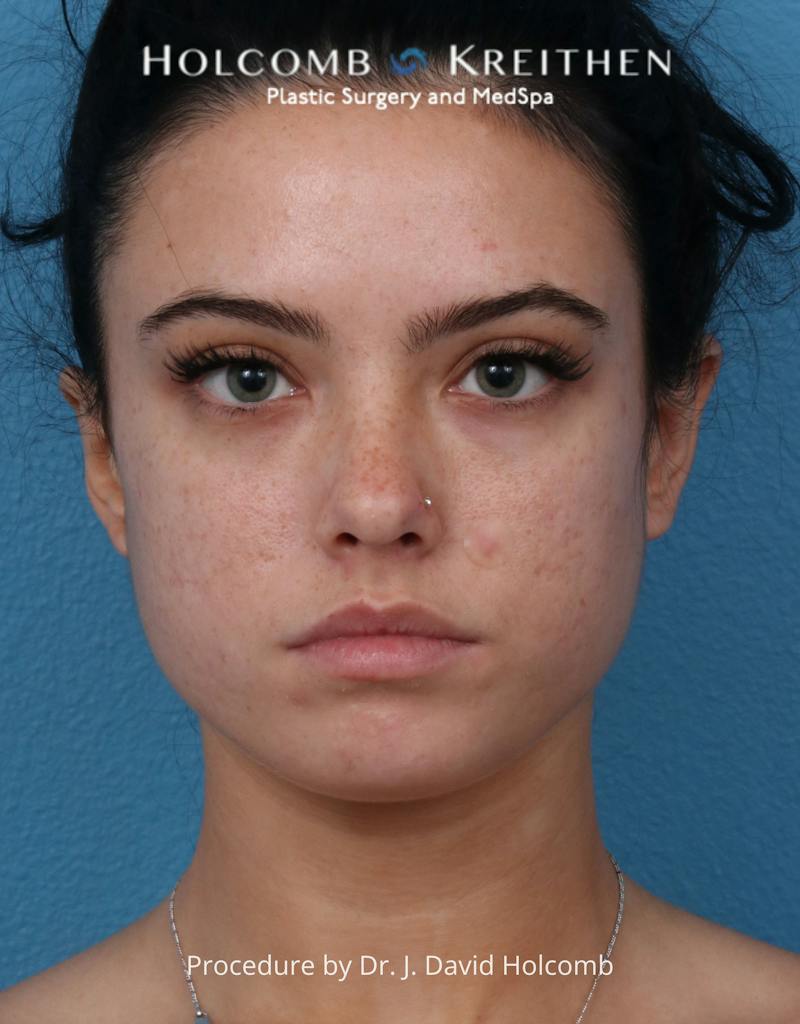 Otoplasty Before & After Gallery - Patient 378397 - Image 2