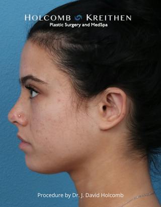 Otoplasty Before & After Gallery - Patient 378397 - Image 8