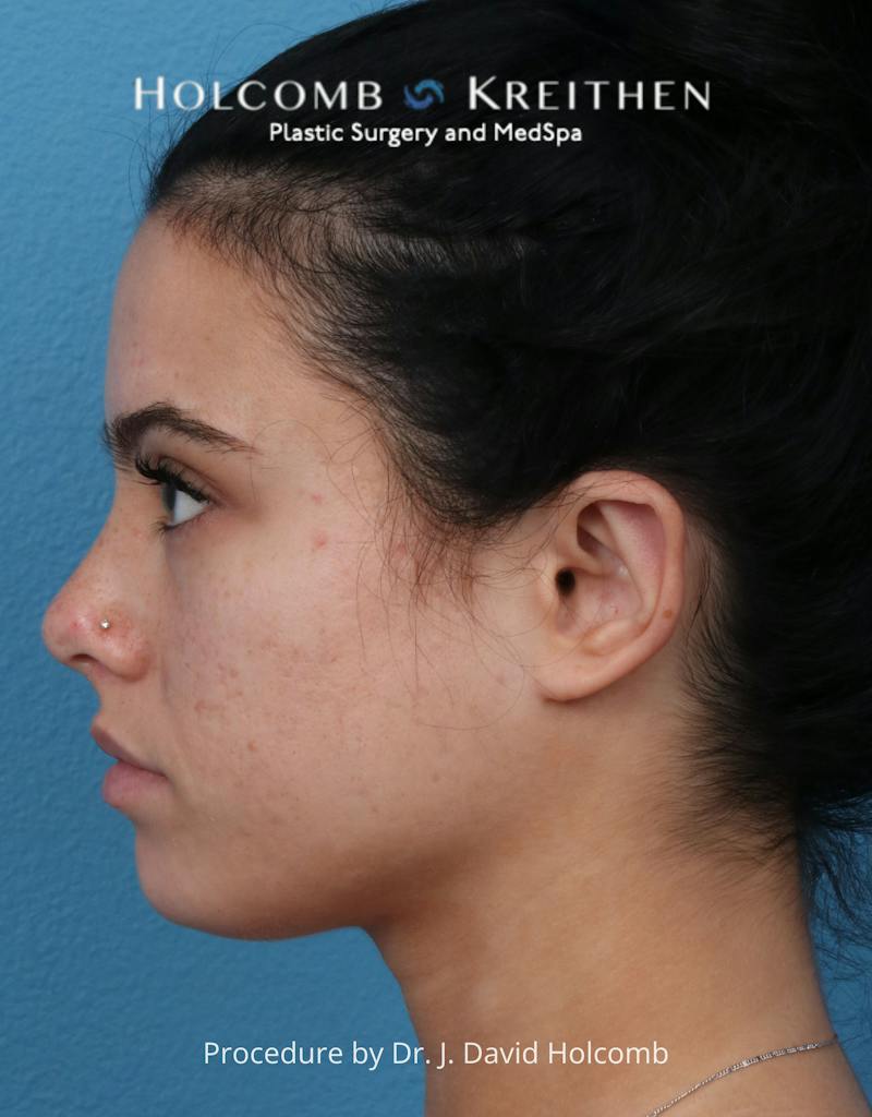 Otoplasty Before & After Gallery - Patient 378397 - Image 8