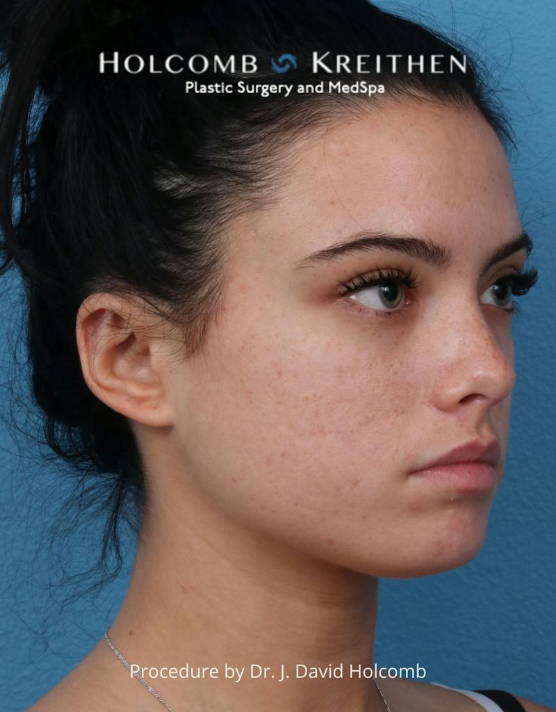 Otoplasty Before & After Gallery - Patient 378397 - Image 4