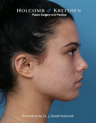 Otoplasty Before & After Gallery - Patient 378397 - Image 6