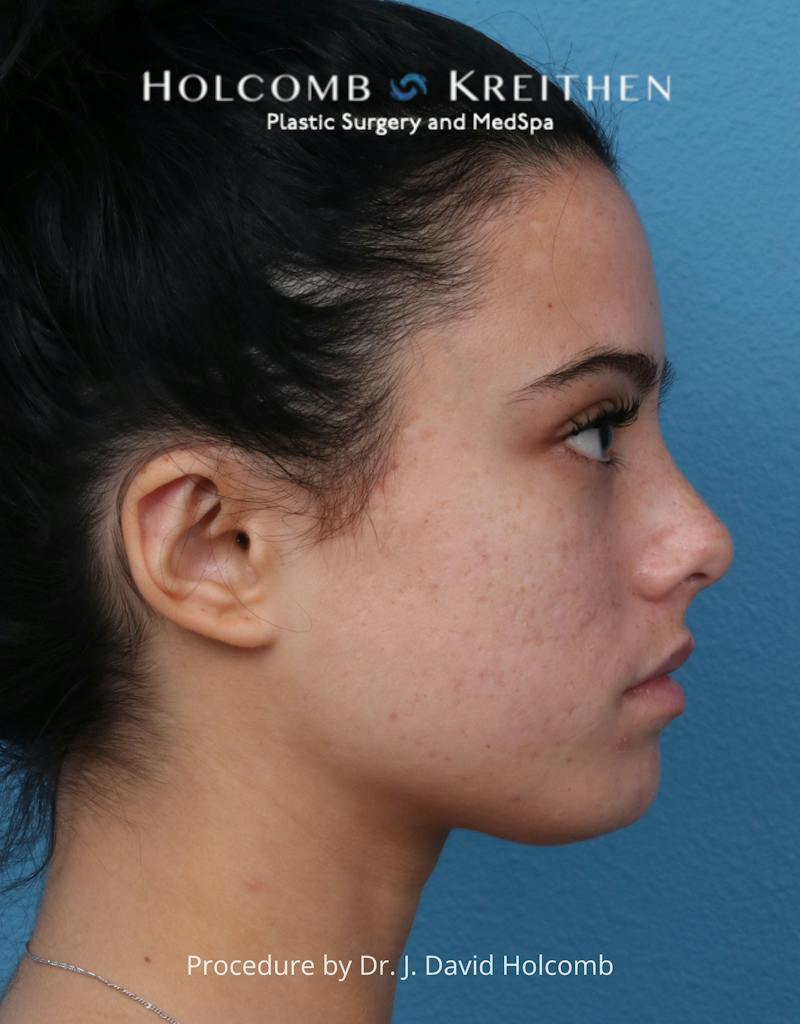 Otoplasty Before & After Gallery - Patient 378397 - Image 6