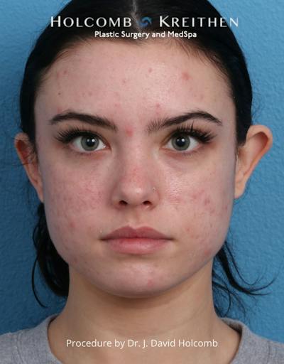 Otoplasty Before & After Gallery - Patient 378397 - Image 1