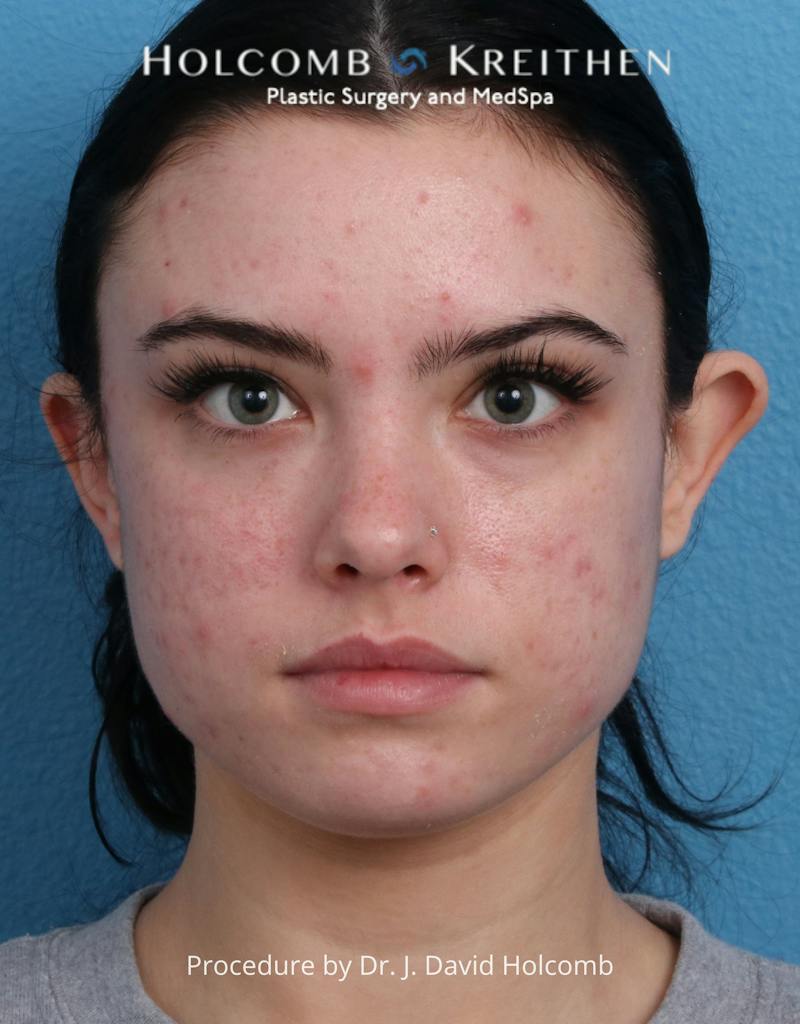 Otoplasty Before & After Gallery - Patient 378397 - Image 1