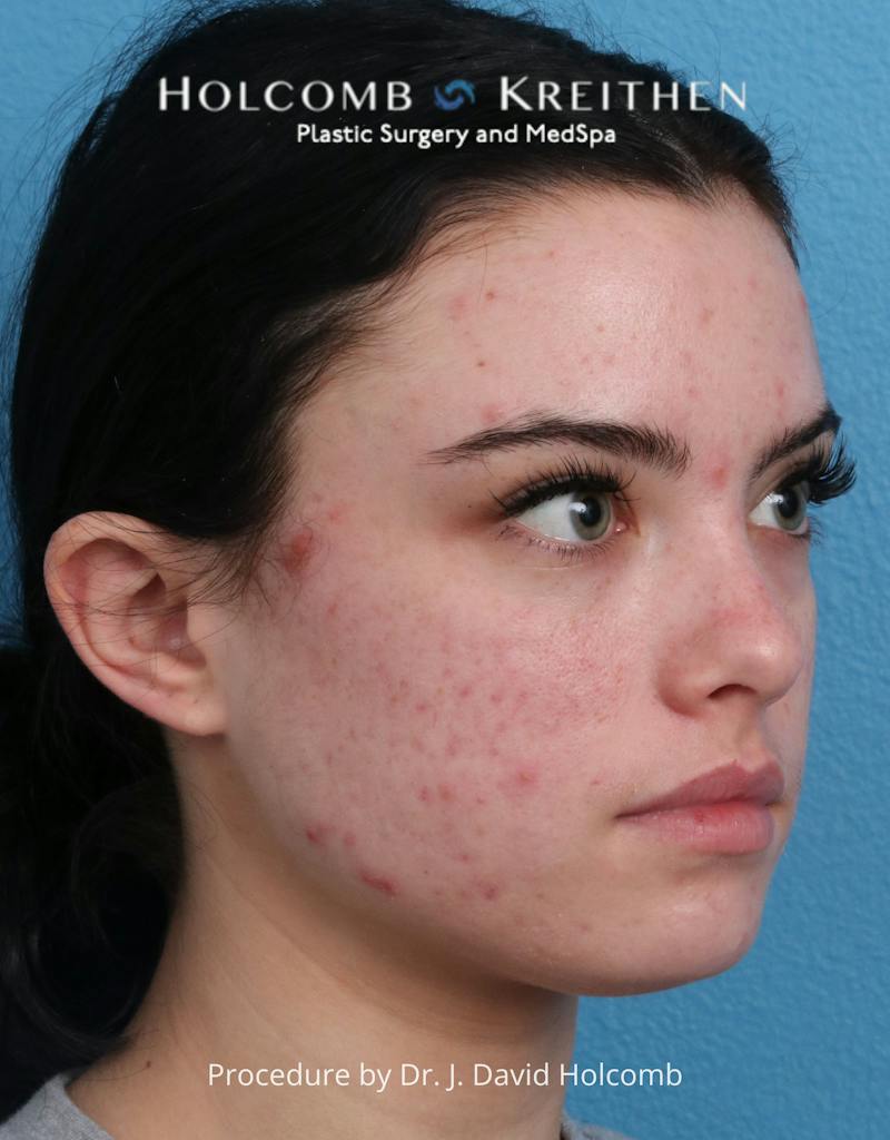 Otoplasty Before & After Gallery - Patient 378397 - Image 3