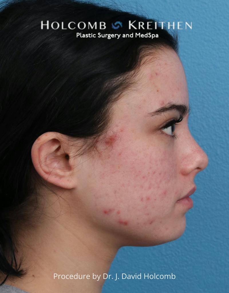Otoplasty Before & After Gallery - Patient 378397 - Image 5