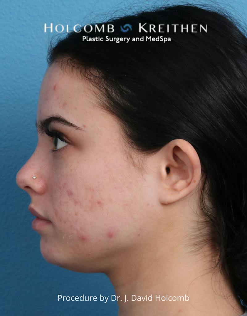 Otoplasty Before & After Gallery - Patient 378397 - Image 7