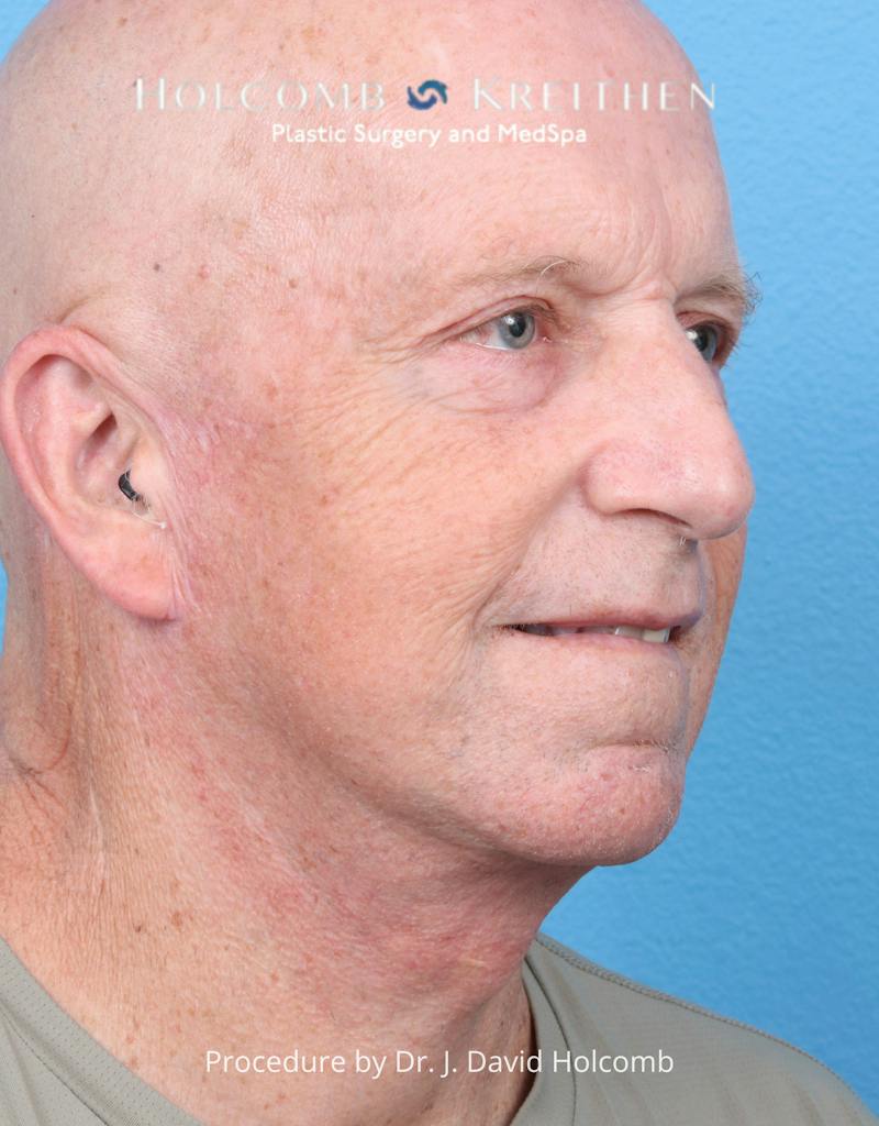 Facelift Before & After Gallery - Patient 701838 - Image 2
