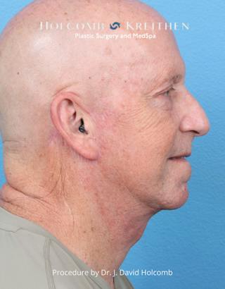 Facelift Before & After Gallery - Patient 701838 - Image 4