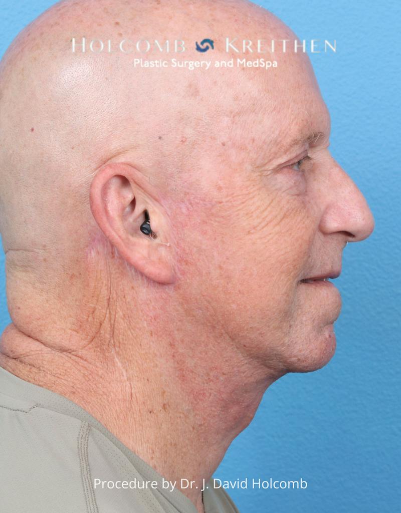 Facelift Before & After Gallery - Patient 701838 - Image 4