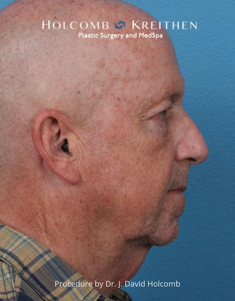 Facelift Before & After Gallery - Patient 701838 - Image 3