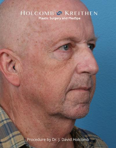 Facelift Before & After Gallery - Patient 701838 - Image 1