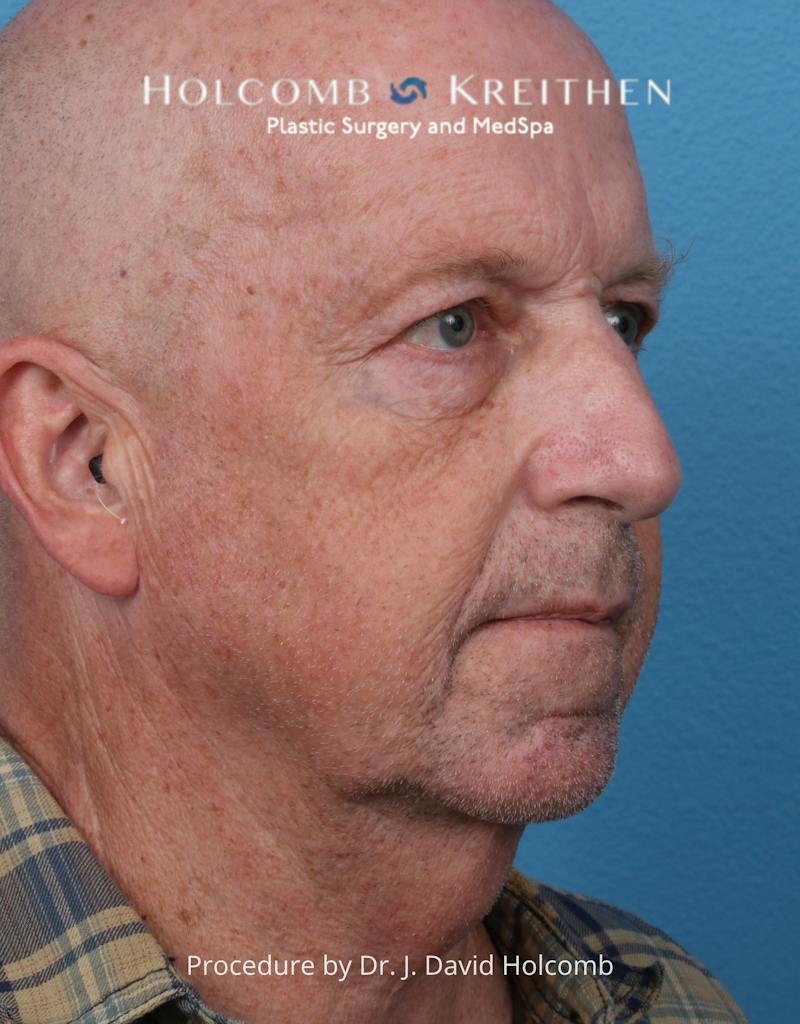 Facelift Before & After Gallery - Patient 701838 - Image 1