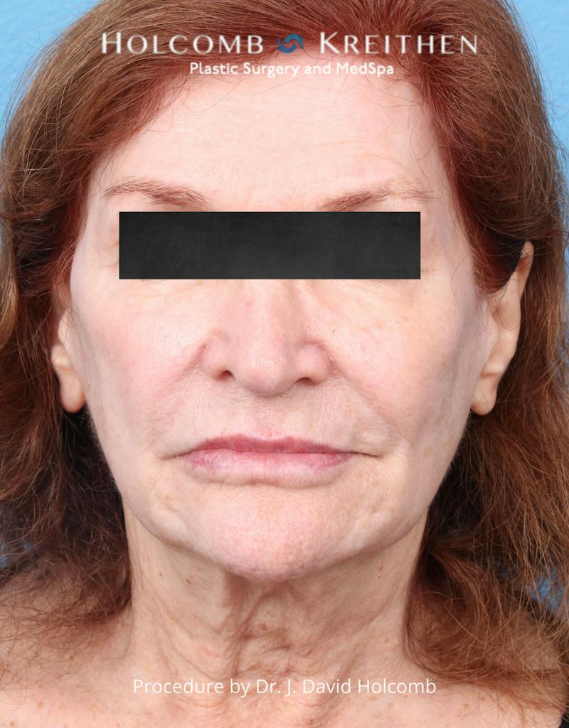 Facelift Before & After Gallery - Patient 271981 - Image 1