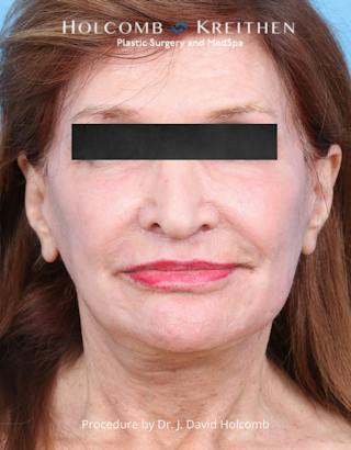 Facelift Before & After Gallery - Patient 271981 - Image 2