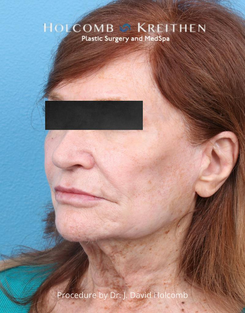 Facelift Before & After Gallery - Patient 271981 - Image 3