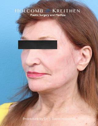 Facelift Before & After Gallery - Patient 271981 - Image 4