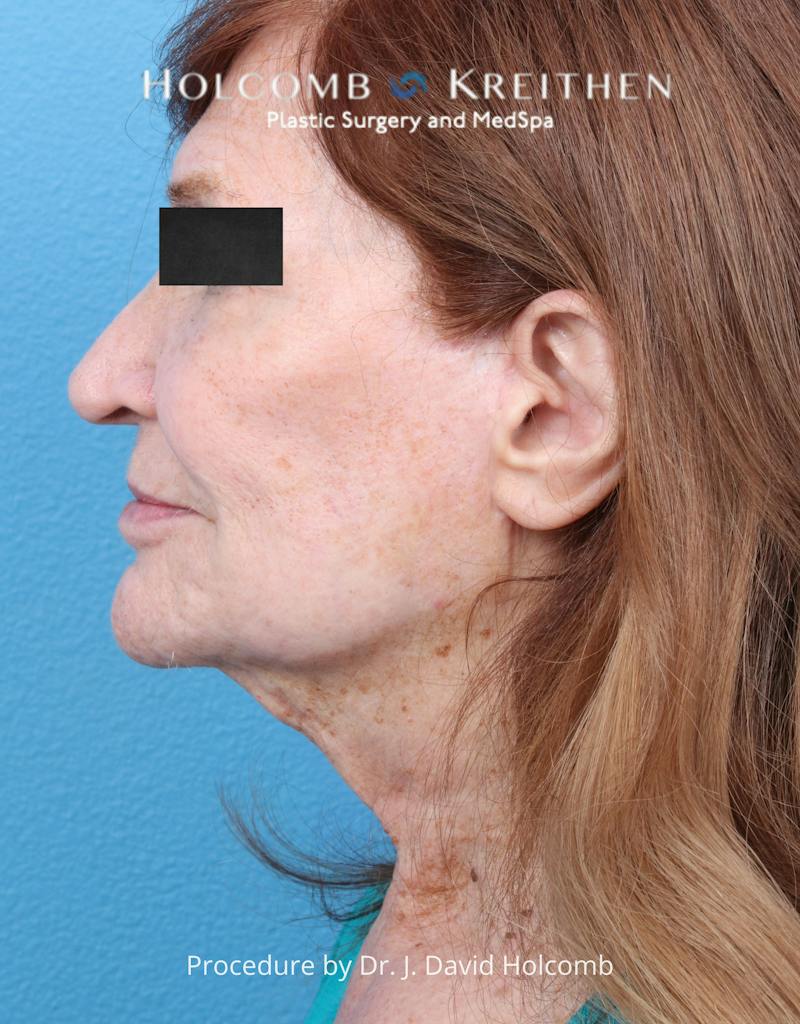 Facelift Before & After Gallery - Patient 271981 - Image 5