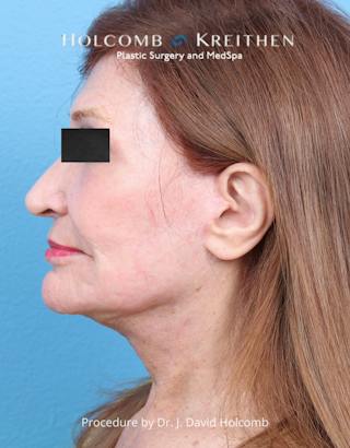 Facelift Before & After Gallery - Patient 271981 - Image 6