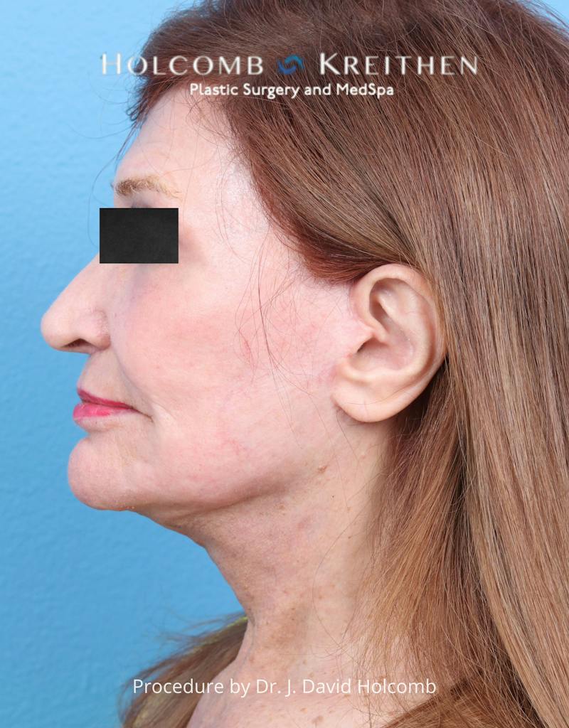 Facelift Before & After Gallery - Patient 271981 - Image 6