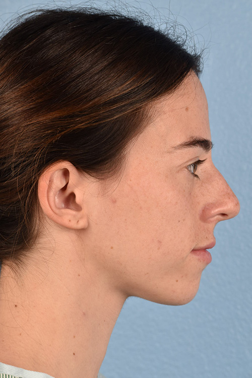 Rhinoplasty Before & After Gallery - Patient 172099 - Image 1